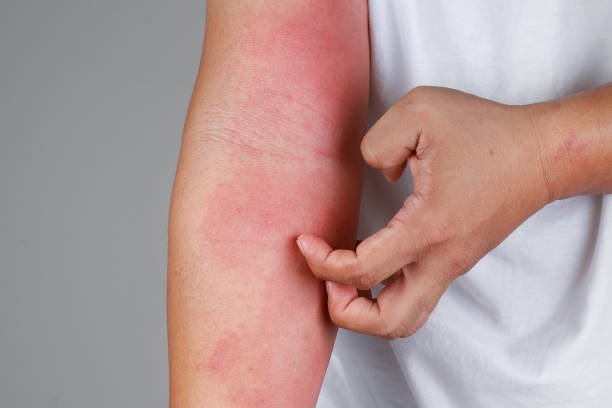 a close up of bad psoriasis on a person's arm