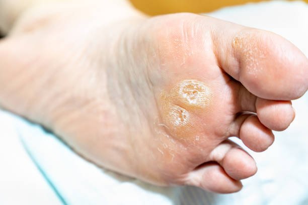 photograph of corn on the sole of the foot