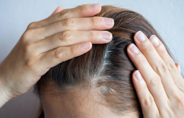 female pattern hair loss can progress from a widening part to overall thinning.