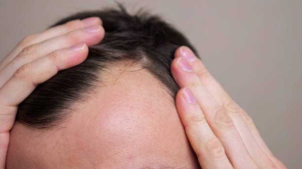man with bald spots suffering from hair loss. treatment of hair problem.
