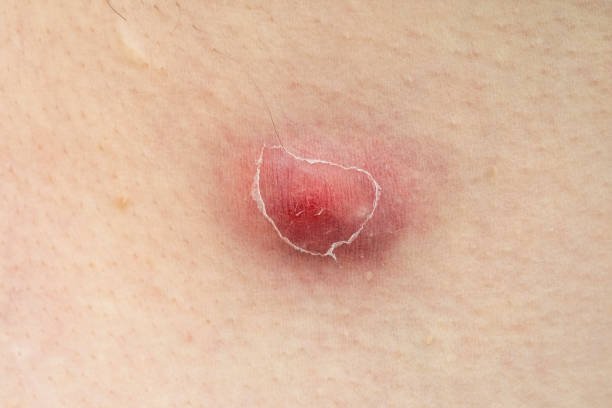 close up of furuncle, acne, pimple with pus under skin