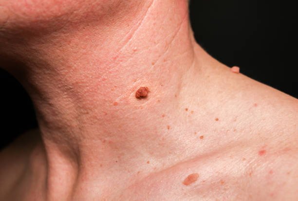big birthmark on the man's skin. medical health photo. papillomas on the neck.