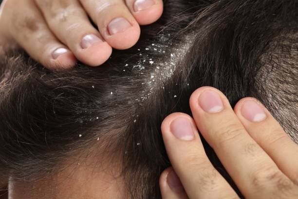 man with dandruff in his dark hair, macro view