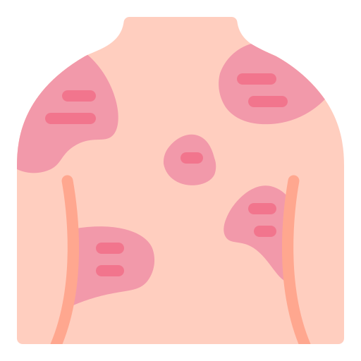 psoriasis